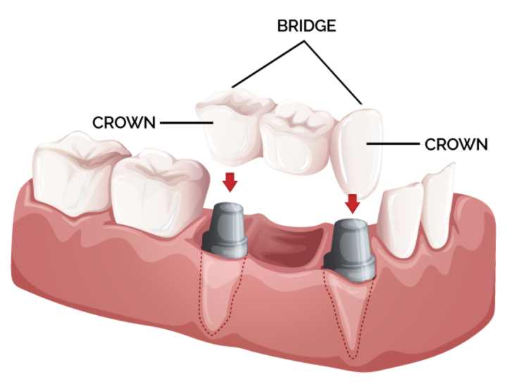 نوعی ترمیم دندان است که تمامی سطوح آن را میپوشاند 